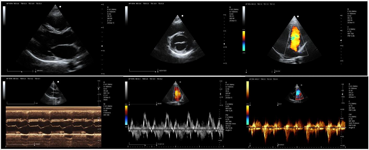 color doppler result