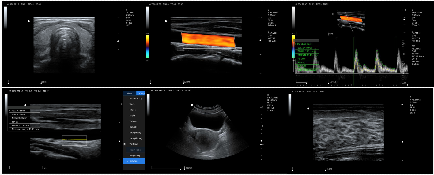 color doppler picture